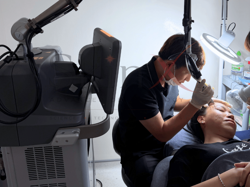 Laser CO2 Fractional có thể xử lý được khá nhiều loại sẹo khác nhau 